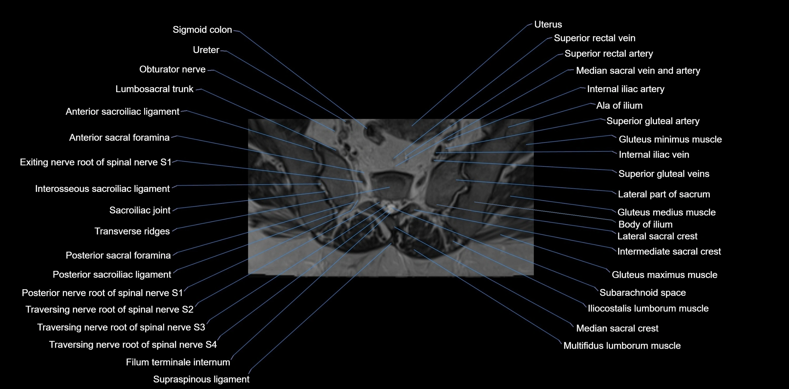 MRI sacrum, coccyx and sacroiliac joint axial cross sectional anatomy 3T  radiology  image-img-00001-00021.webp